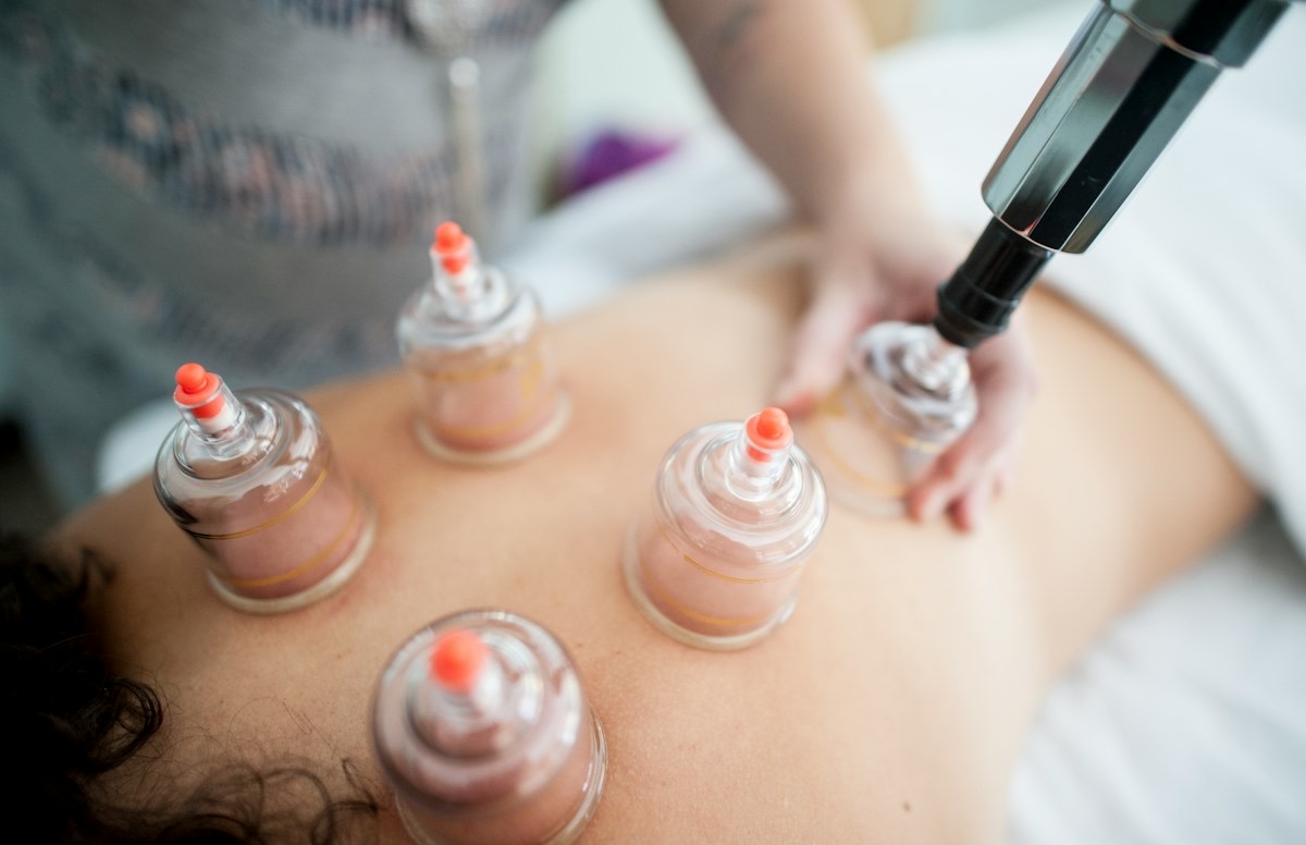 Cupping terapija